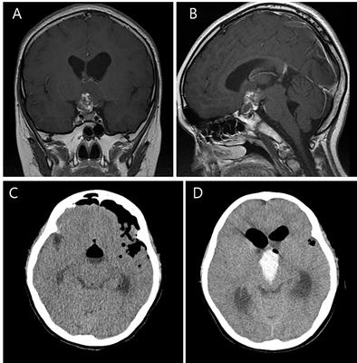 Complications of Endoscopic Skull Base Surgery for Sellar and Parasellar Tumors in Pediatric Population; Neurosurgical Perspectives